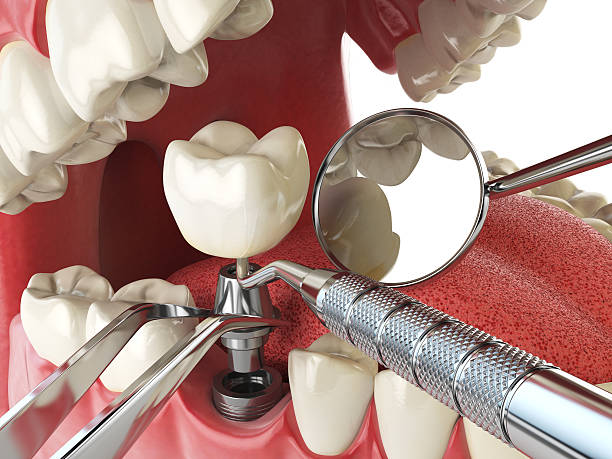 Best Emergency Wisdom Teeth Removal in Uniondale, NY